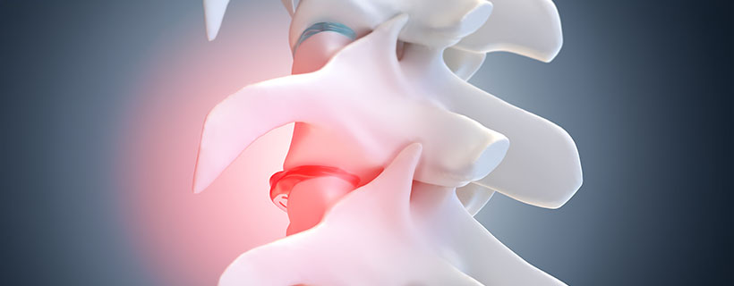 patient needing Degenerative Disc Disease in need of Spinal Decompression Therapy in Colville