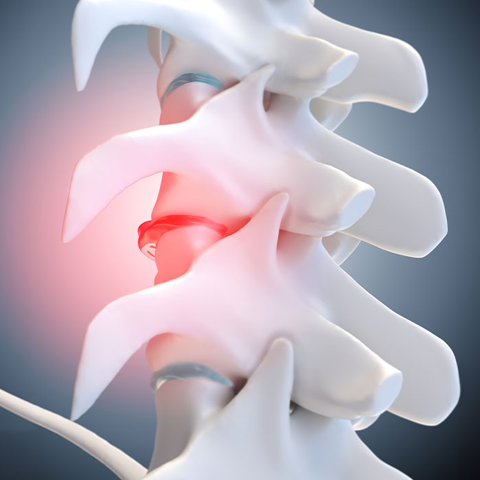 degenerative Disc Disease treatment in Colville