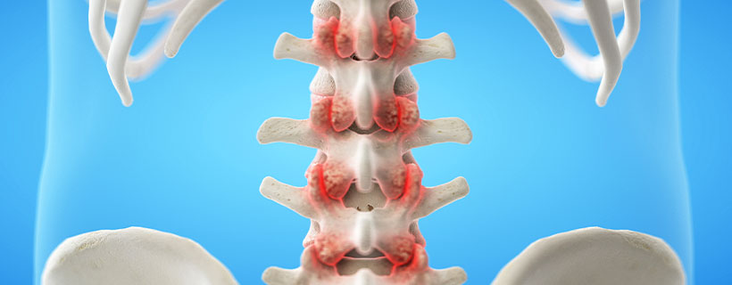 patient needing Facet Joint Syndrome in need of Spinal Decompression Therapy in Colville
