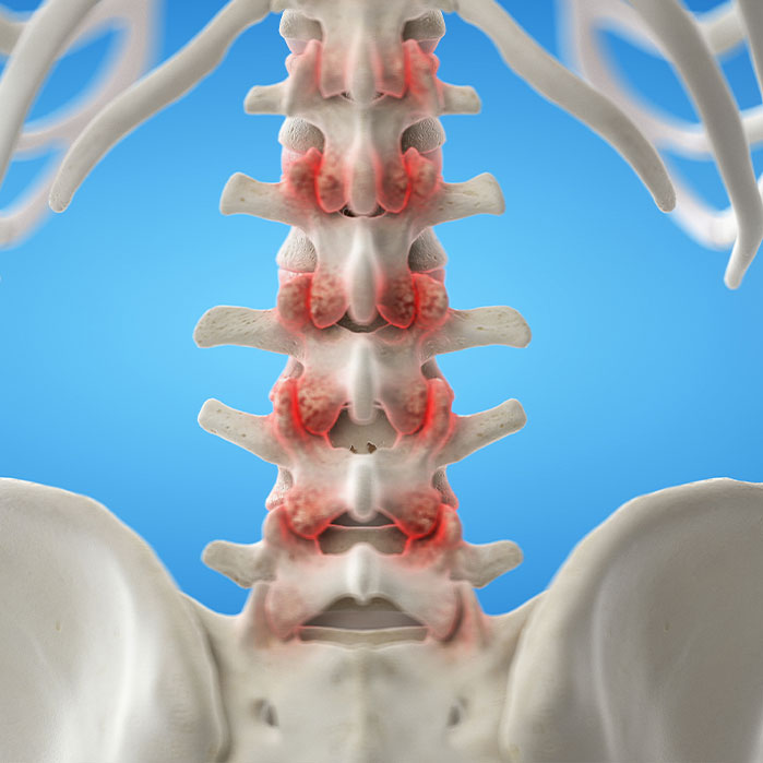 facet Joint Syndrome treatment in Colville