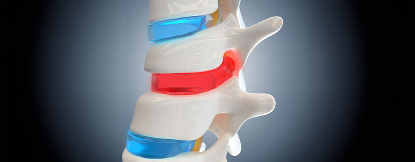 patient needing herniated disc in need of Spinal Decompression Therapy in Colville