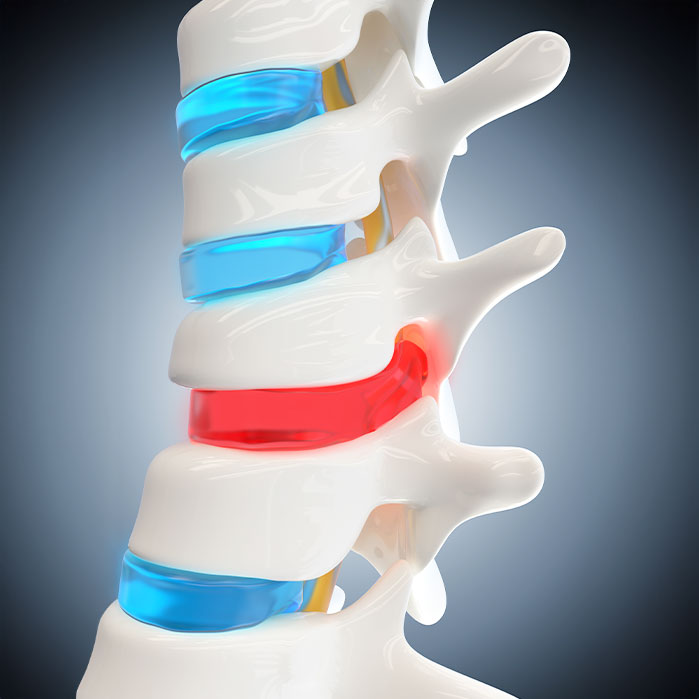 herniated Disc treatment in Colville