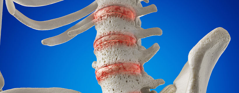 patient needing osteoarthritis in need of Spinal Decompression Therapy in Colville