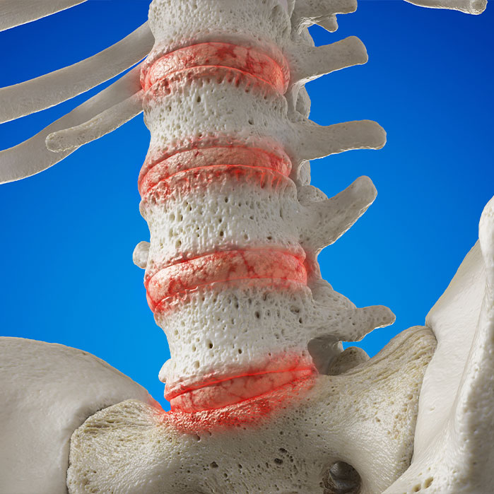 osteoarthritis treatment in Colville
