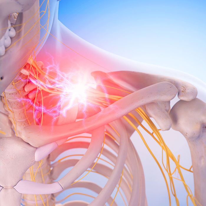 pinched nerve treatment in Colville