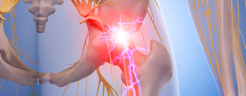 patient needing sciatica in need of Spinal Decompression Therapy in Colville