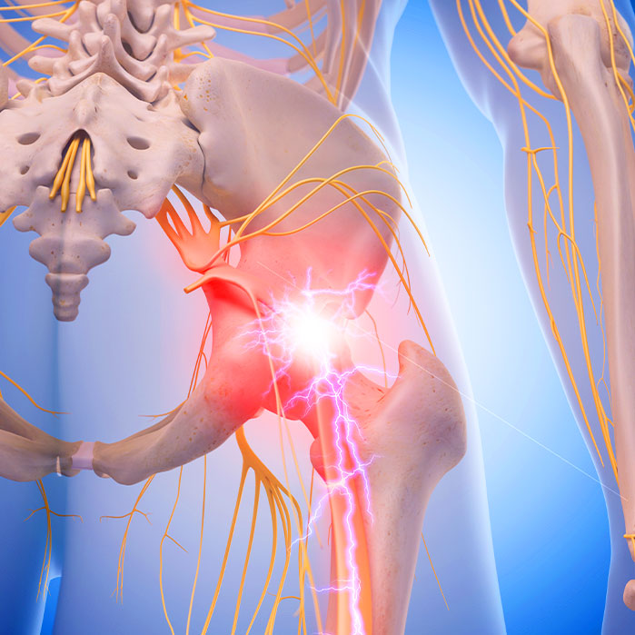 sciatica treatment in Colville