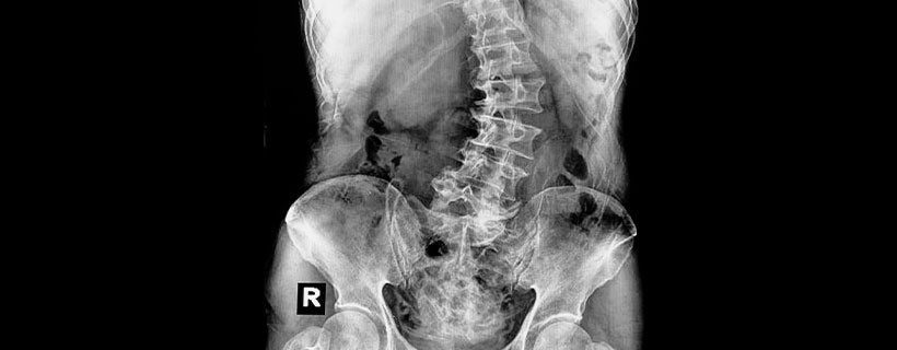 patient needing scoliosis in need of Spinal Decompression Therapy in Colville