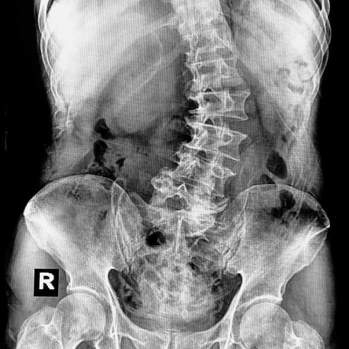 scoliosis treatment in Colville