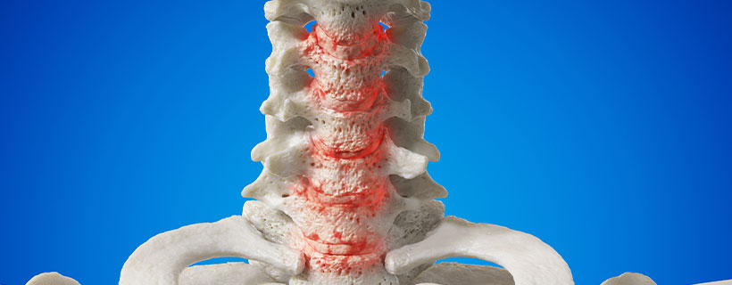 patient needing Spondylosis in need of Spinal Decompression Therapy in Colville
