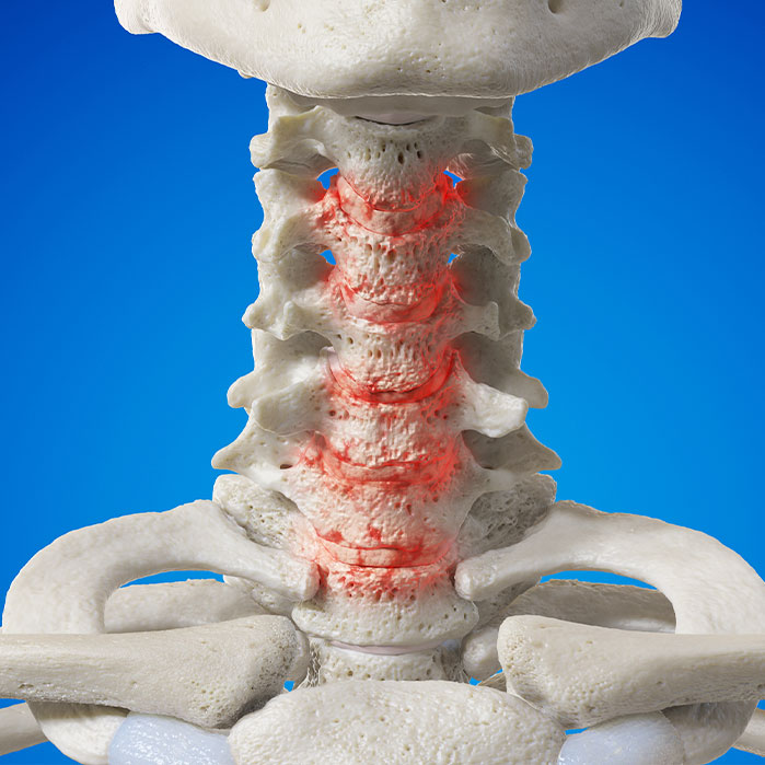 spondylosis treatment in Colville